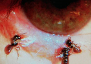 Lee más sobre el artículo Encuentran cuatro abejas viviendo en el ojo de una mujer