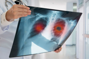 Lee más sobre el artículo 17 de noviembre: Día Internacional del Cáncer de Pulmón