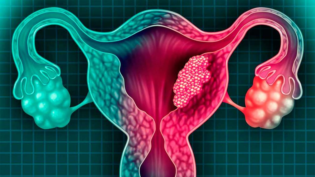 Lee más sobre el artículo Cuáles son los síntomas del cáncer de útero y qué etapas tiene