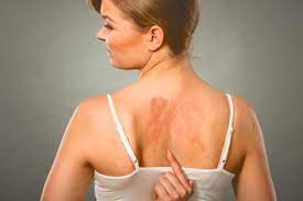 Lee más sobre el artículo Alergia al sol: 5 reacciones cutáneas que indican que algo anda mal