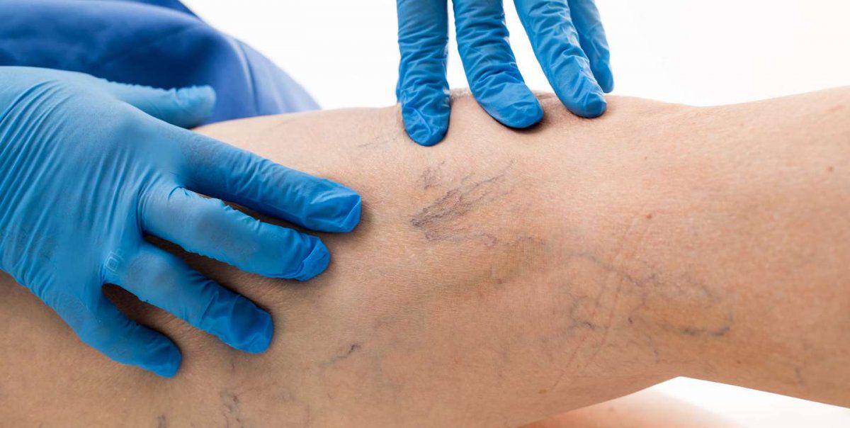 Lee más sobre el artículo Varices en las piernas: por qué se producen y cómo hay que prevenirlas