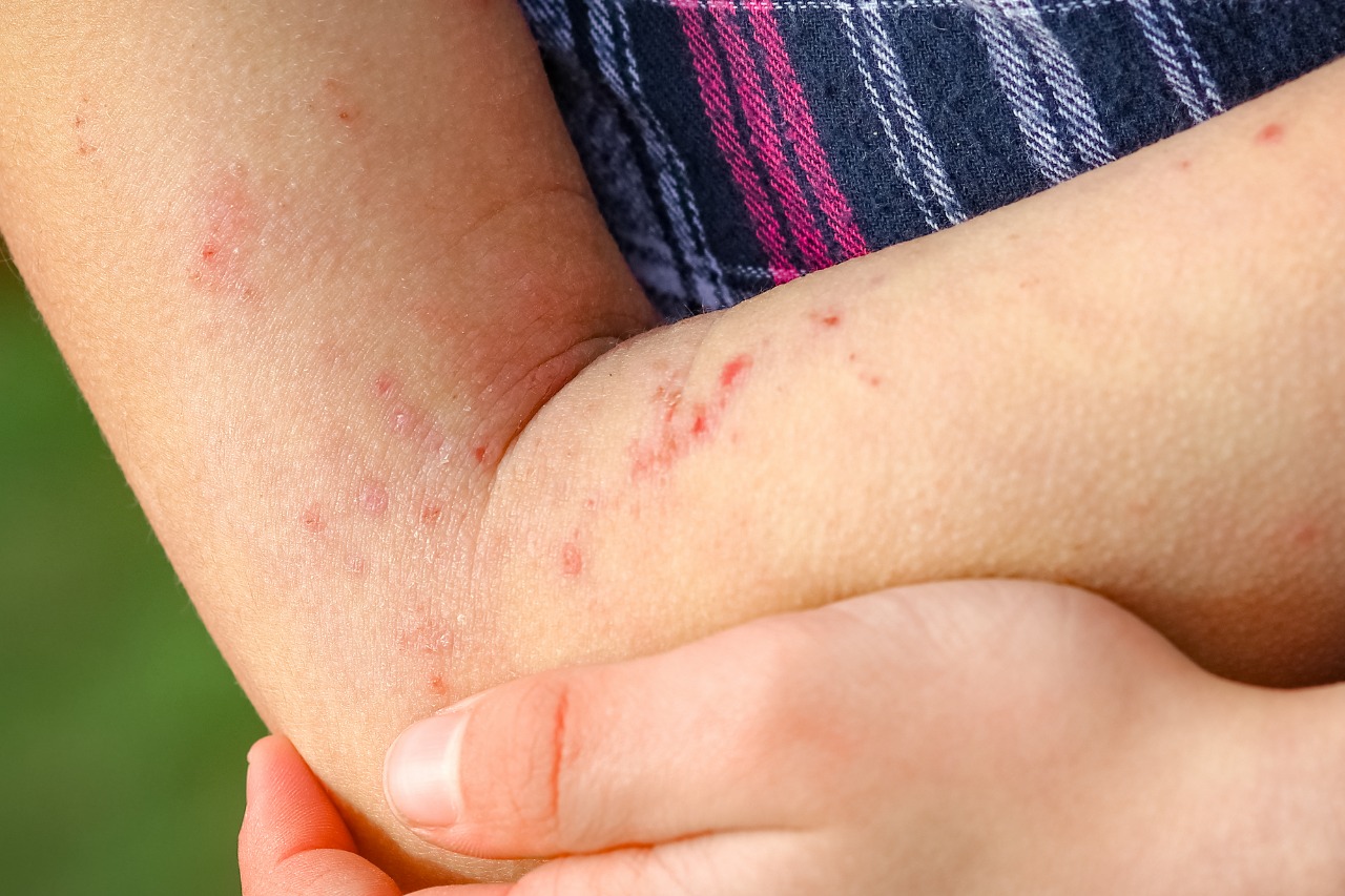Lee más sobre el artículo Día Mundial de la Dermatitis Atópica