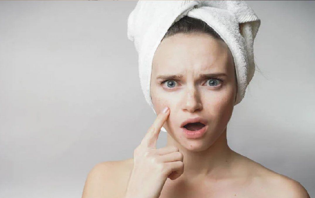 Lee más sobre el artículo Cómo quitar granos de la cara sin dejar ninguna marca