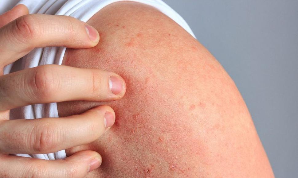 Lee más sobre el artículo ¿Qué es la dermatitis atópica?