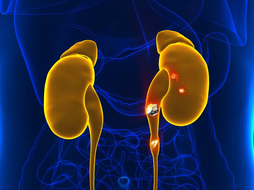 Lee más sobre el artículo Cálculos en el riñón: cómo tratarlos y cuáles son los síntomas más comunes