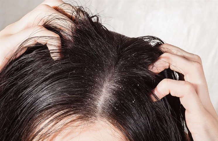 Lee más sobre el artículo Tres señales para saber si el cuero cabelludo está “estresado”