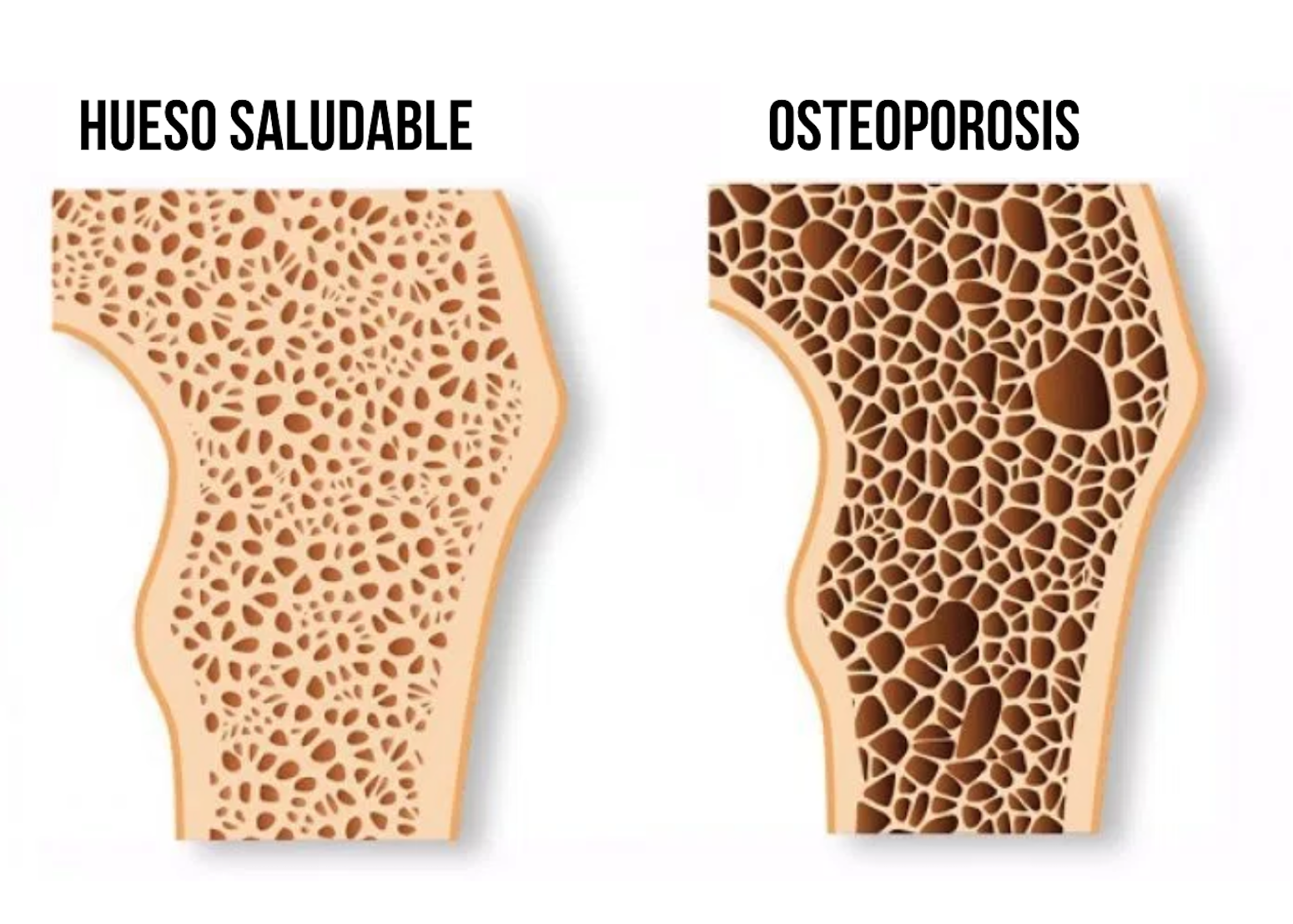 Lee más sobre el artículo Osteoporosis: en Argentina se producen 90 fracturas de cadera por día