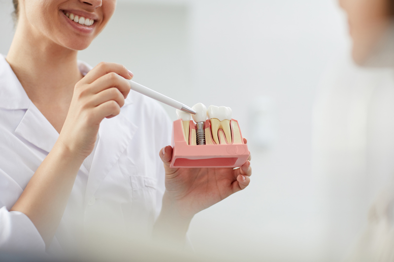 Lee más sobre el artículo Consejos para cuidar los implantes dentales y evitar la posible pérdida de piezas