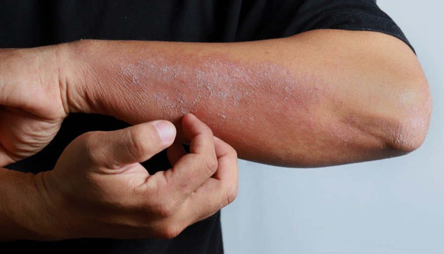 Dermatitis atópica: cómo es el nuevo tratamiento que reduce la picazón y las lesiones