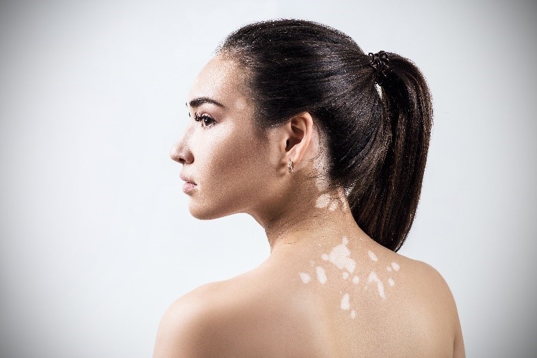Lee más sobre el artículo Todo lo que hay que saber sobre las manchas blancas en la piel y cómo tratarlas