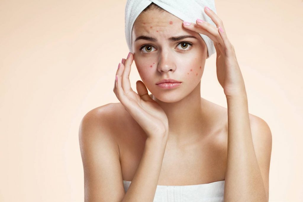 Causas y costo emocional del acné femenino en la adultez